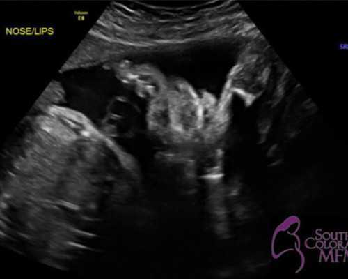 国内代怀宝宝公司,女性唐氏患者可以做三代试管婴儿*育健康宝宝吗